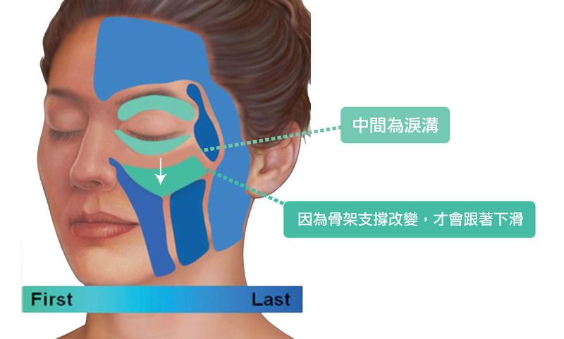 眼下脂肪墊滑落，導致淚溝出現。