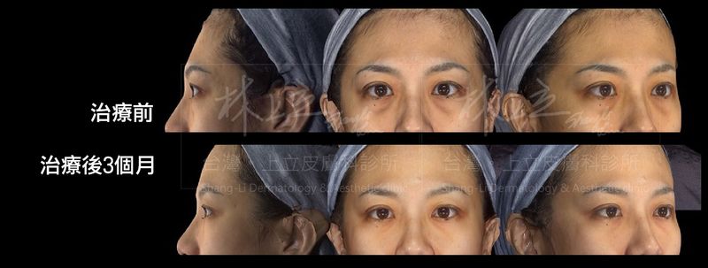 艾麗斯重建眼眶骨的支撐之後，有效改善淚溝凹陷，連同黑眼圈也因而淡化許多