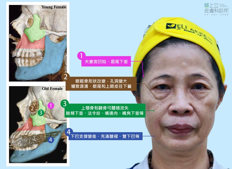 淚溝、法令紋或木偶紋，我們看見的所有皺紋、凹陷和鬆弛，都是臉部老化