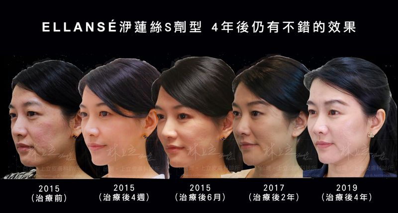 洢蓮絲因為可以刺激皮膚自己的膠原蛋白新生，維持時間更久。可見在追蹤洢蓮絲Ｓ劑型治療後2年，依然維持著不錯的效果