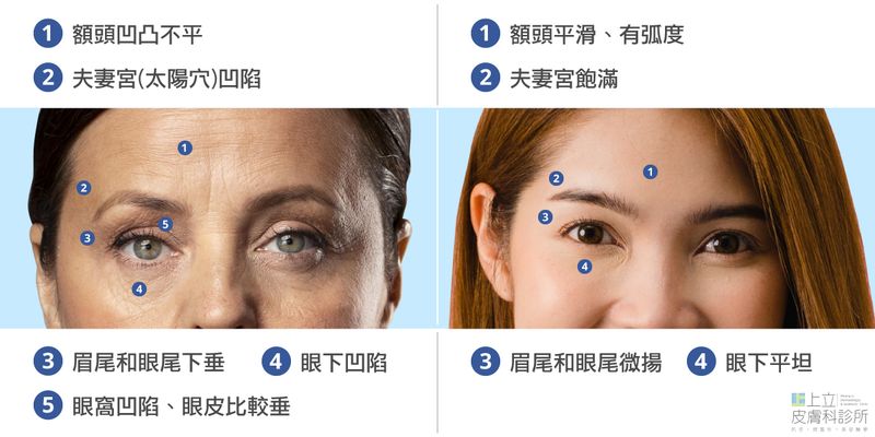 夫妻宮凹陷，眼尾下垂、眉尾下垂，淚溝、眼袋、眼下塌陷都是老化現象