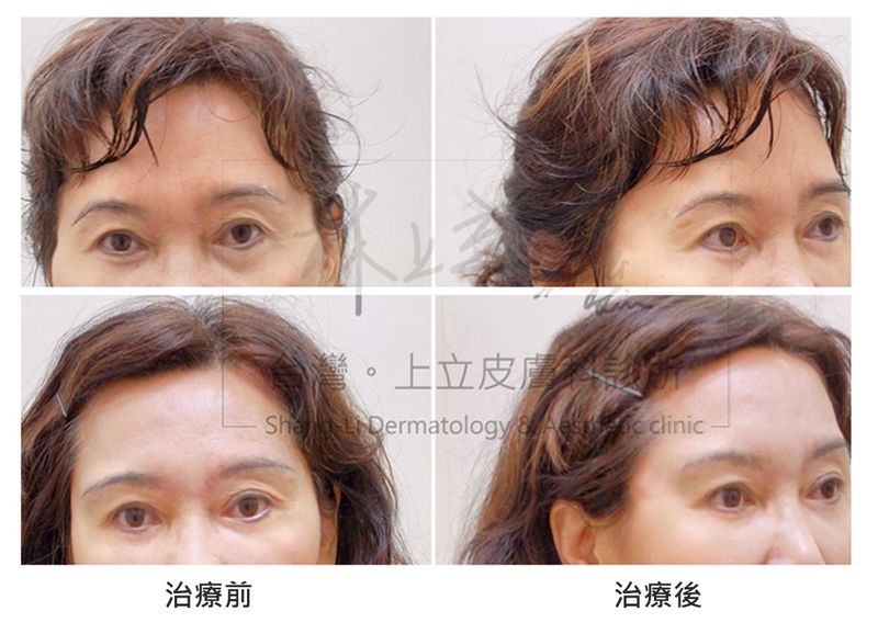 透過Ellans&eacute;洢蓮絲重建眼眶骨的骨架支撐之後，淚溝改善，整體臉型都變得更加年輕柔和。