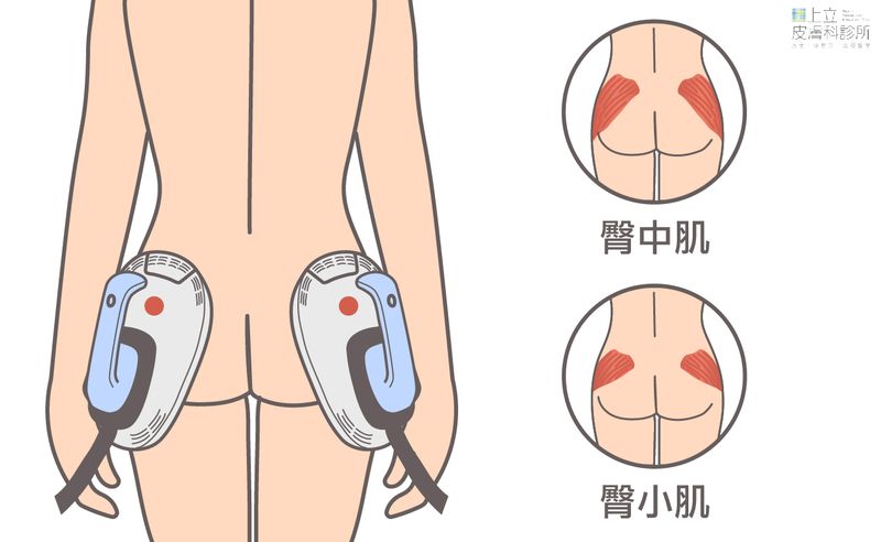 EMSCULPT肌動減脂探頭擺放於臀部外側，能同步刺激臀中肌與臀小肌