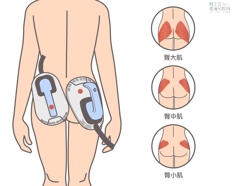 EMSCULPT肌動減脂透過醫師專業的探頭擺放設計，能達到調整臀型