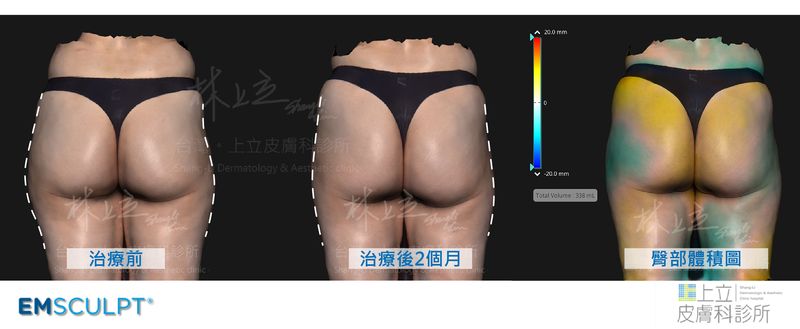 心形臀接受EMSCULPT肌動減脂治療後，由於前後立體度增加