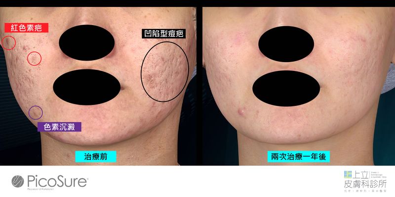 Picosure755蜂巢皮秒雷射，可用於治療色素型痘疤以及輕微的凹陷型痘疤