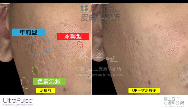 UP雷射一次治療後的效果，可看見肌膚變得更加平整