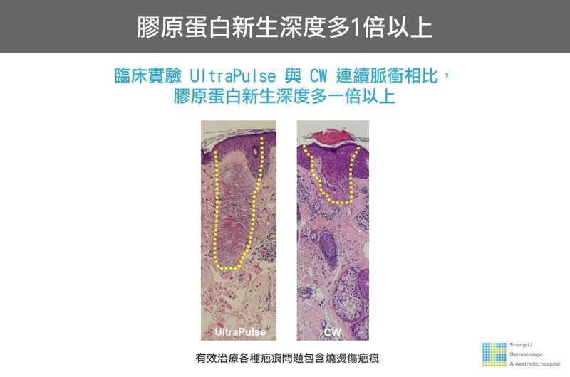 UP雷射能促使膠原蛋白新生，與傳統的飛梭雷射相比，治療深度更深