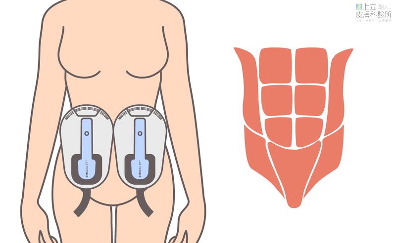 EMSCULPT均勻的刺激腹部肌群，強化核心，提升基礎代謝率。