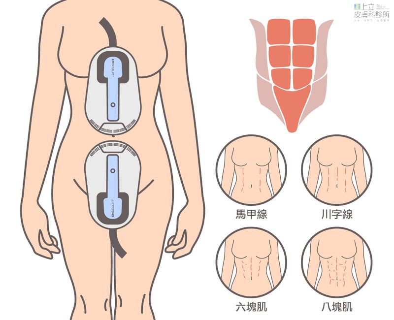 EMSCULPT可集中刺激腹直肌，使馬甲線、川字線、六塊肌和八塊肌腹肌形狀更明顯。