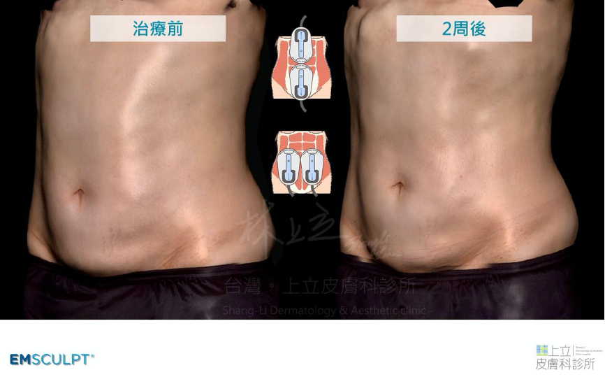 EMSCULPT肌動減脂療程兩周後，腰部曲線更明顯，六塊肌浮現。