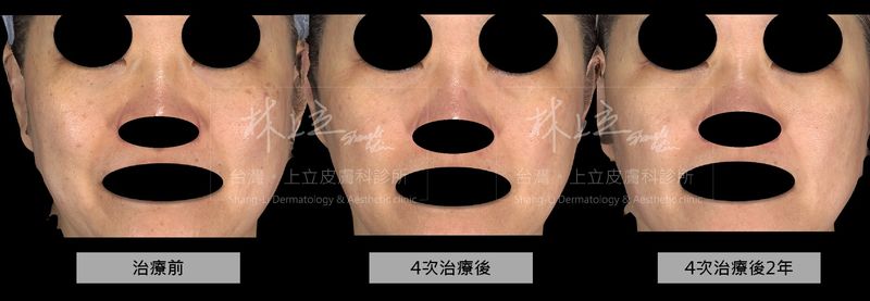 經過4次治療之後，斑點、毛孔和細紋的狀況都得到明顯改善，並在個案結束治療後的2年回診追蹤膚況