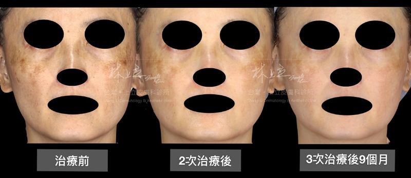 PicoSure755蜂巢皮秒雷射的3次治療之後，可見肝斑的色塊明顯都變淡許多，並且狀況也穩定下來了，在停止治療的第9個月，整體的皮膚狀況穩定
