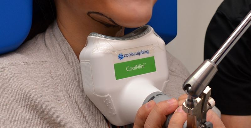 coolsculpting冷凍減脂採取吸附式探頭，需要脂肪厚度大於2.5公分以上才能使用。