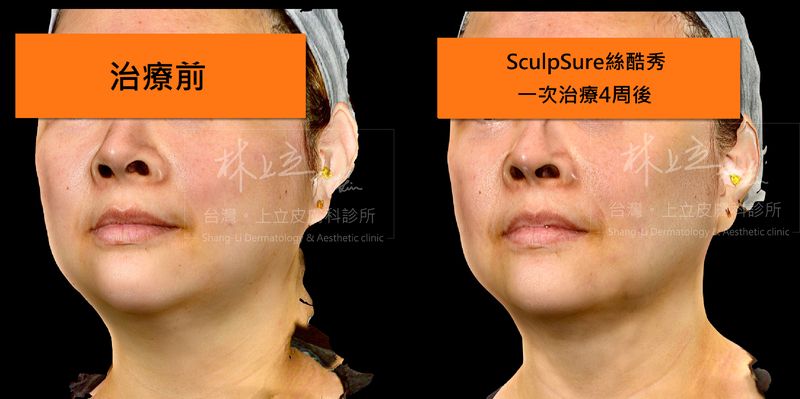 SculpSure絲酷秀案例對於整體輪廓的緊實拉提效果更加明顯。