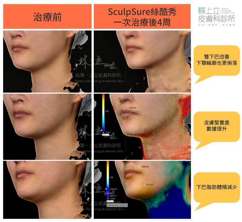 SculpSure絲酷秀案例在一次治療的４周後，不只下巴脂肪體積減少