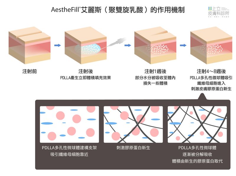 AestheFill艾麗斯聚雙旋乳酸作用機制