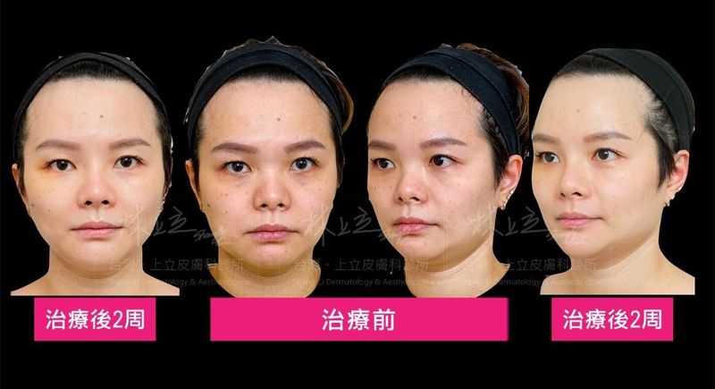 林上立醫師透過洢蓮絲與艾麗斯同時治療兩周後之效果，效果自然漸進