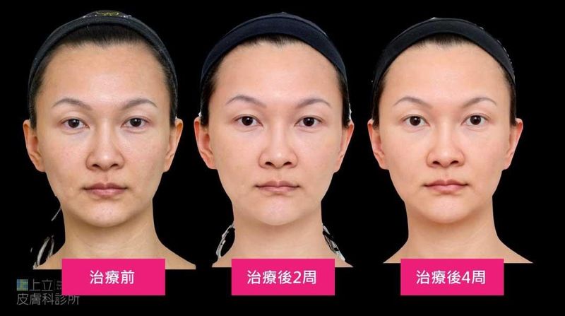 蓮絲豐額後，由於材質支撐性佳
