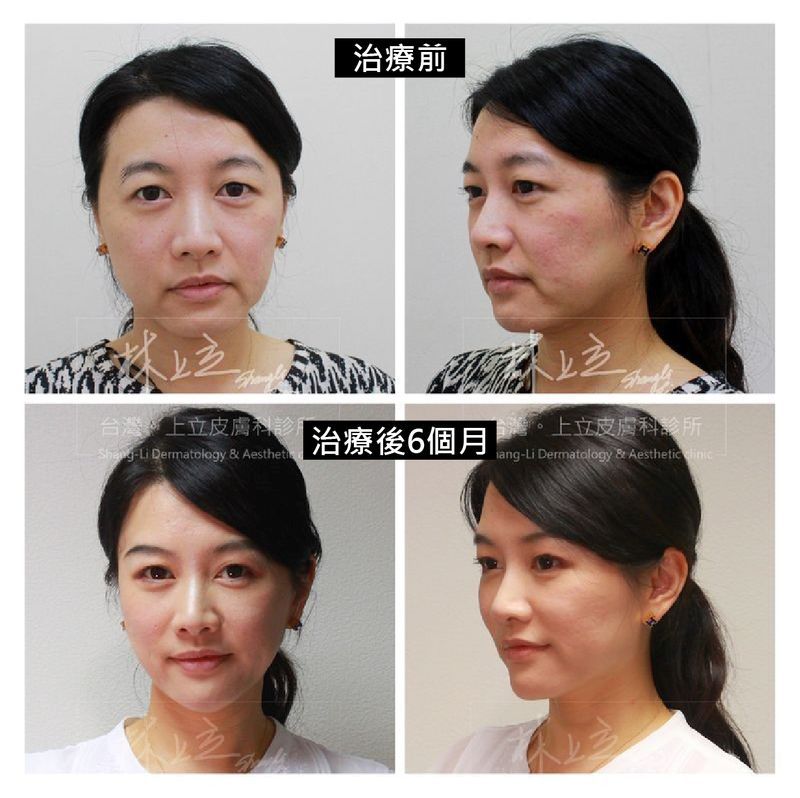 年紀增長，臉部骨架也會逐漸流失、支撐力變差