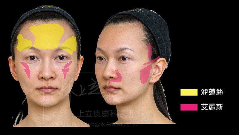結合洢蓮絲和艾麗斯一起治療，擷取不同材質的優勢，讓改善幅度、效果呈現時間都更符合每個人的期待。