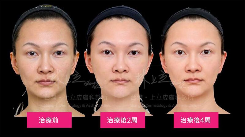 額頭、夫妻宮，在第一時間就給予有效支撐，恢復額頭的飽滿度
