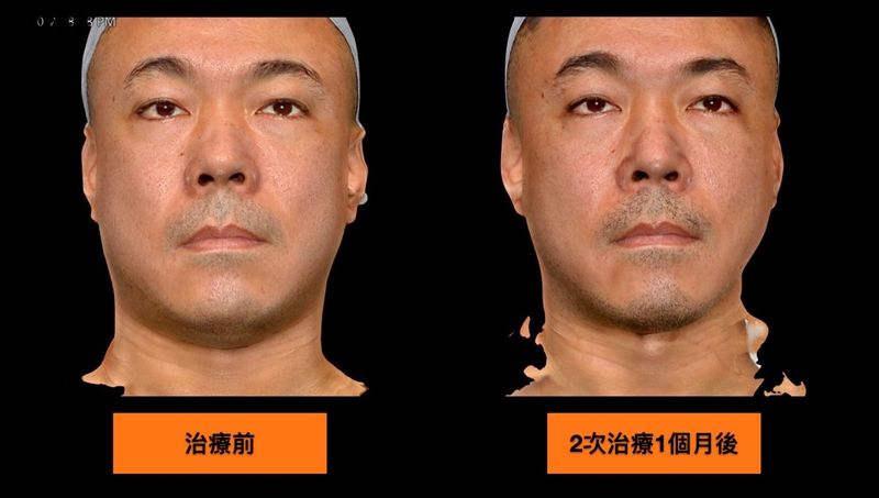 SculpSure絲酷秀(熱塑)２次治療後，雙下巴區域的脂肪減少了，不只讓下顎線條變俐落