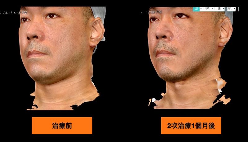SculpSure絲酷秀(熱塑)針對下巴脂肪具有很好的減脂效果，還可以提升皮膚的緊實度，對於下顎線的俐落度有明顯提升效果。