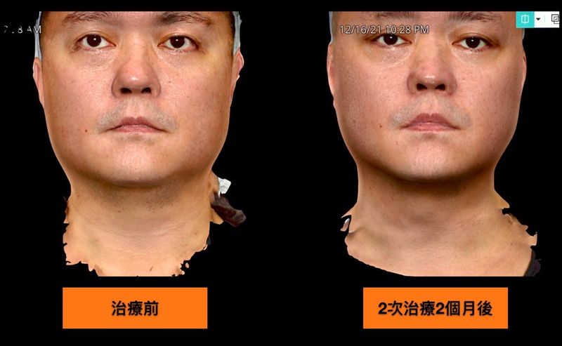 絲酷秀2次治療後，隨著雙下巴改善，並且下顎皮膚緊實拉提後，臉部輪廓線逐漸明確