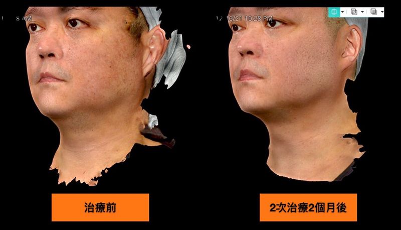 絲酷秀治療後，側面看起來更加明顯。
