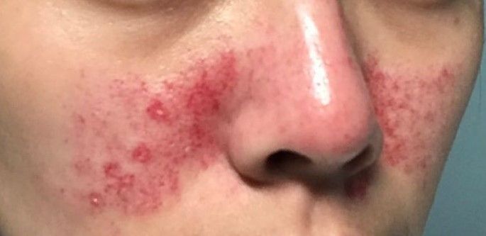 許多人認為皮秒雷射就是要打到皮下出血，治療效果會更好。
