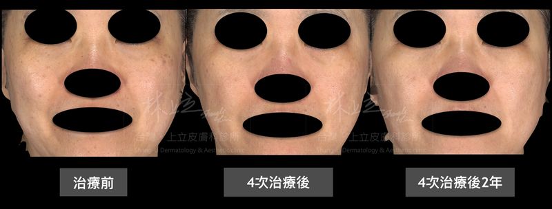 皮秒雷射治療後1、2年，皮膚依舊維持良好狀態