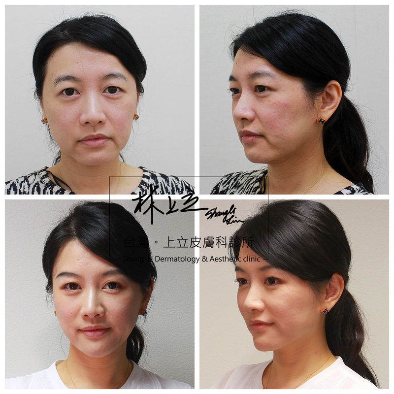 洢蓮絲施打當下即可見效果，改善臉頰下垂、木偶紋、雙下巴、眼尾下垂