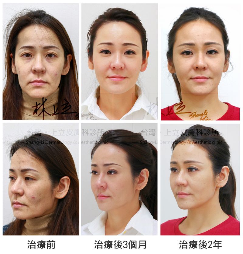 洢蓮絲術維持二年維持的效果依然非常不錯