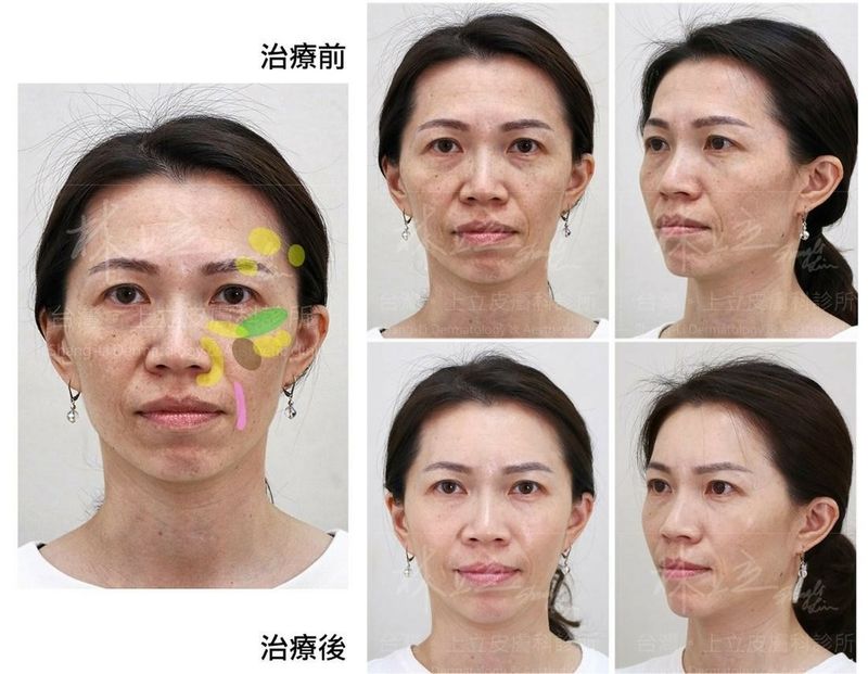 洢蓮絲治療兩周後，立即改善淚溝、眼尾下垂、法令紋，整個人看起來更有精神、膚質也更好。