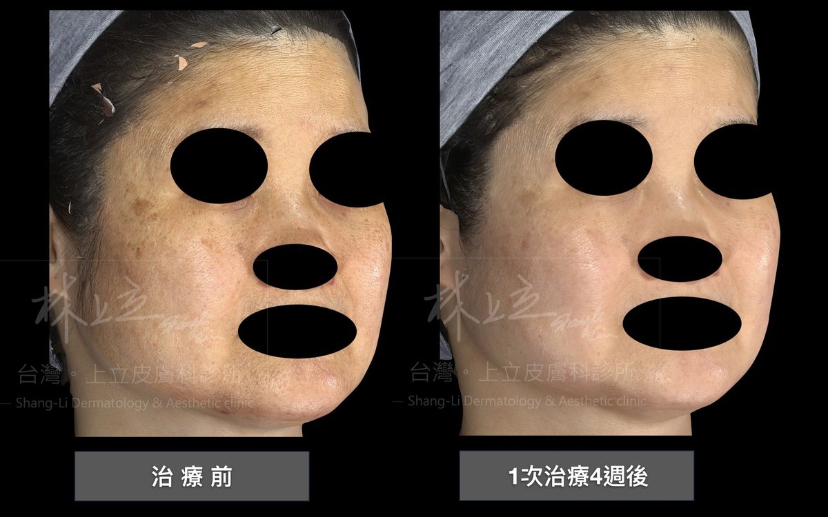 Stellar心動光（新一代M22彩衝光）一次可以處理多種複雜的臉部問題
