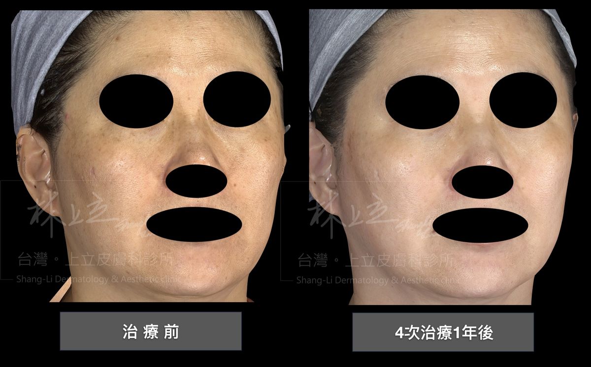 Stellar心動光也能給予相當不錯的改善效果，並且提升膚質健康度