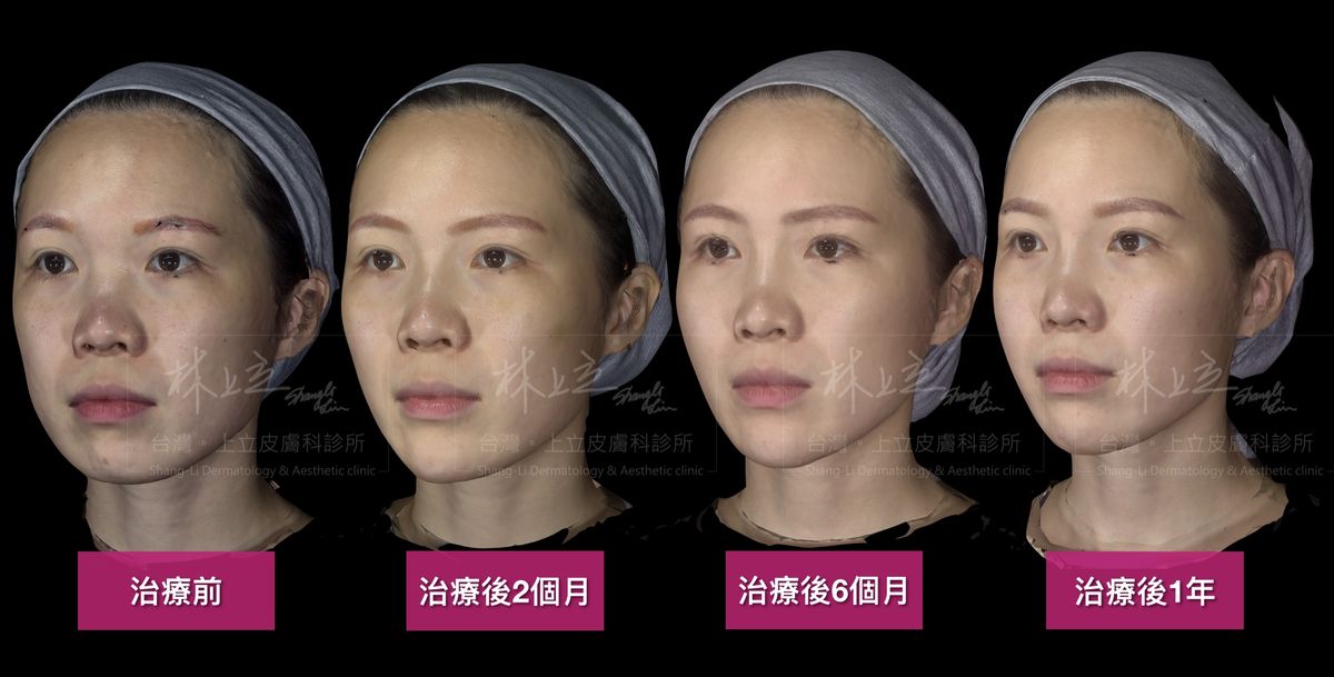 AestheFill艾麗斯的治療效果必須等待皮膚膠原蛋白的自然生長，才會慢慢顯現出來