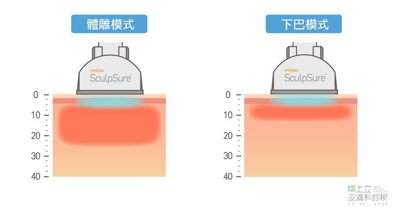 SculpSure熱塑溶脂雙下巴專用探頭減少能量深度避免損傷其他皮膚組織。