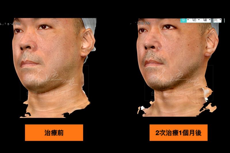 SculpSure絲酷秀（熱塑溶脂）在加熱脂肪進行破壞時，還可以緊實皮膚