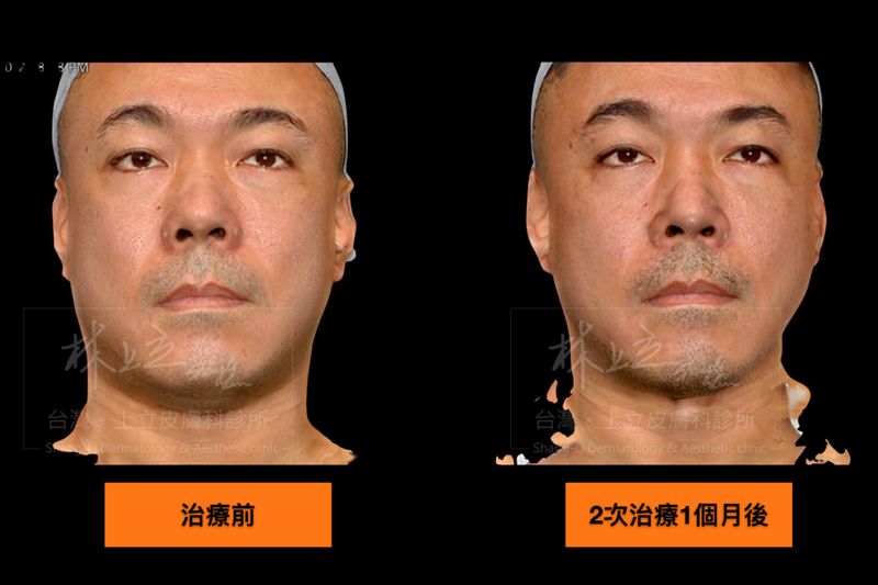 SculpSure絲酷秀（熱塑溶脂）當雙下巴區域的脂肪減少了，整張臉的比例也跟著改變，整張臉看起來彷彿小了一號，感覺變瘦許多。