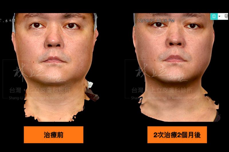 SculpSure熱塑溶脂（絲酷秀）治療前後從正面照看起來一樣有明顯差異。
