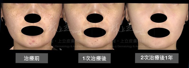 皮秒雷射1次治療後，效果已經有很明顯的改善