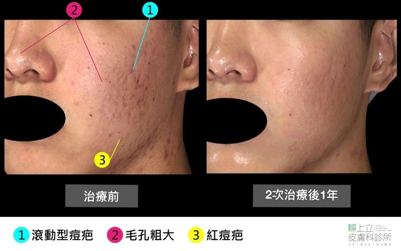 PicoSure755蜂巢皮秒雷射利用２次治療就達到很好的改善滾動型痘疤效果