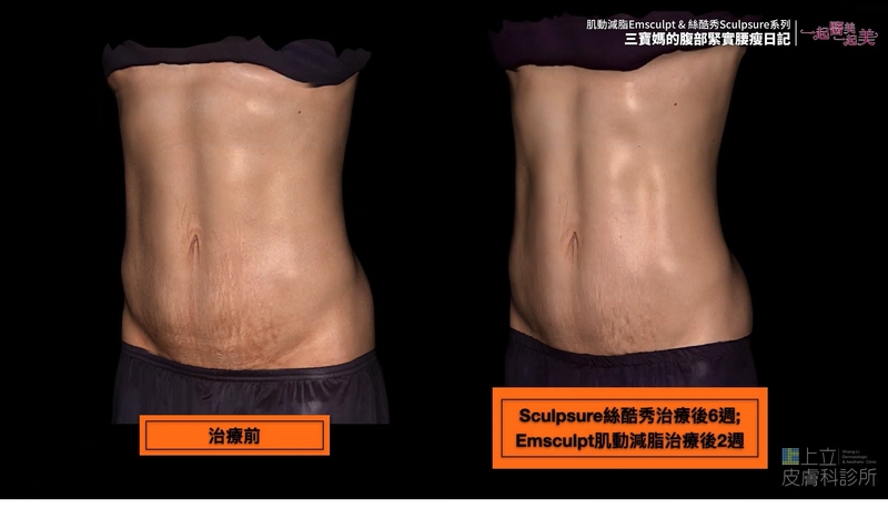 EMSCULPT熱塑溶脂治療後腹部肌膚也相對緊實許多。