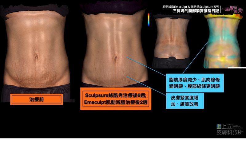 EMSCULPT熱塑溶脂治療後一個月，Ada的整體腰圍已明顯縮小，肌肉強度增加。