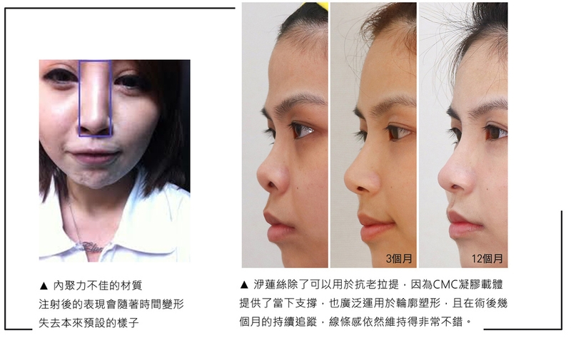 ELLANS&Eacute;洢蓮絲因為內聚力高，可見在治療後一年效果依然維持很不錯的狀況。