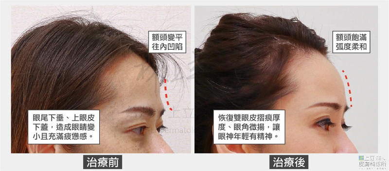 ELLANS&Eacute;洢蓮絲治療前額頭弧度明顯往內凹陷，治療後則恢復到飽滿柔和弧度。