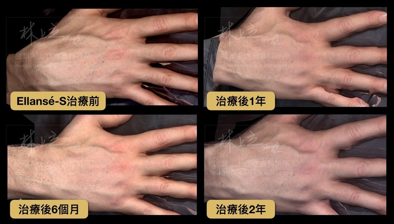 ELLANS&Eacute;洢蓮絲對於雞爪手也有很好的治療效果