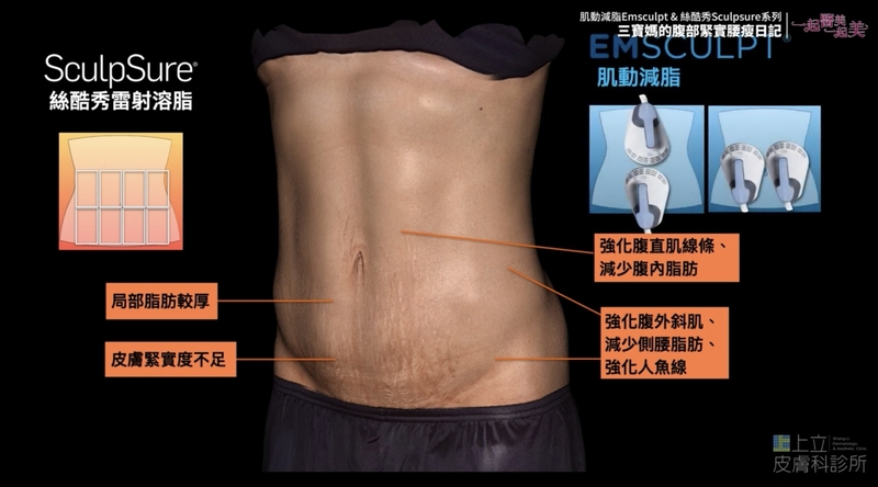 Ada透過EMSCULPT熱塑溶脂來幫助自己更進一步雕塑理想的腹部肌肉線條